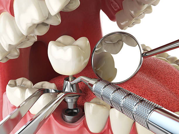 Best Emergency Dentist for Knocked-Out Tooth in Union, OH